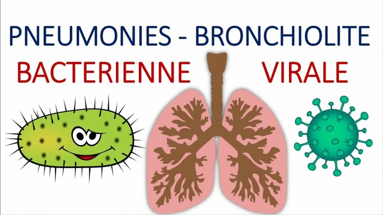 Bronchite vs Pneumonie : comment faire la différence ?